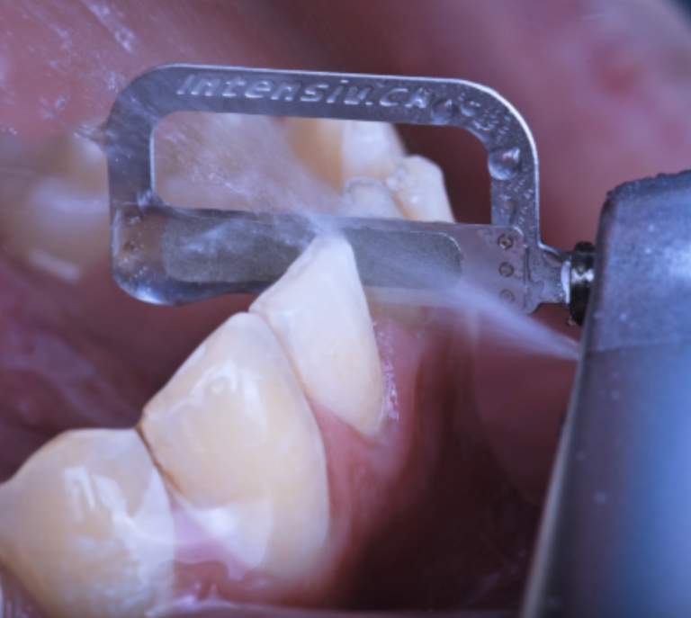 Le stripping dentaire - Cabinet Decines Ortho - Orthodontistes
