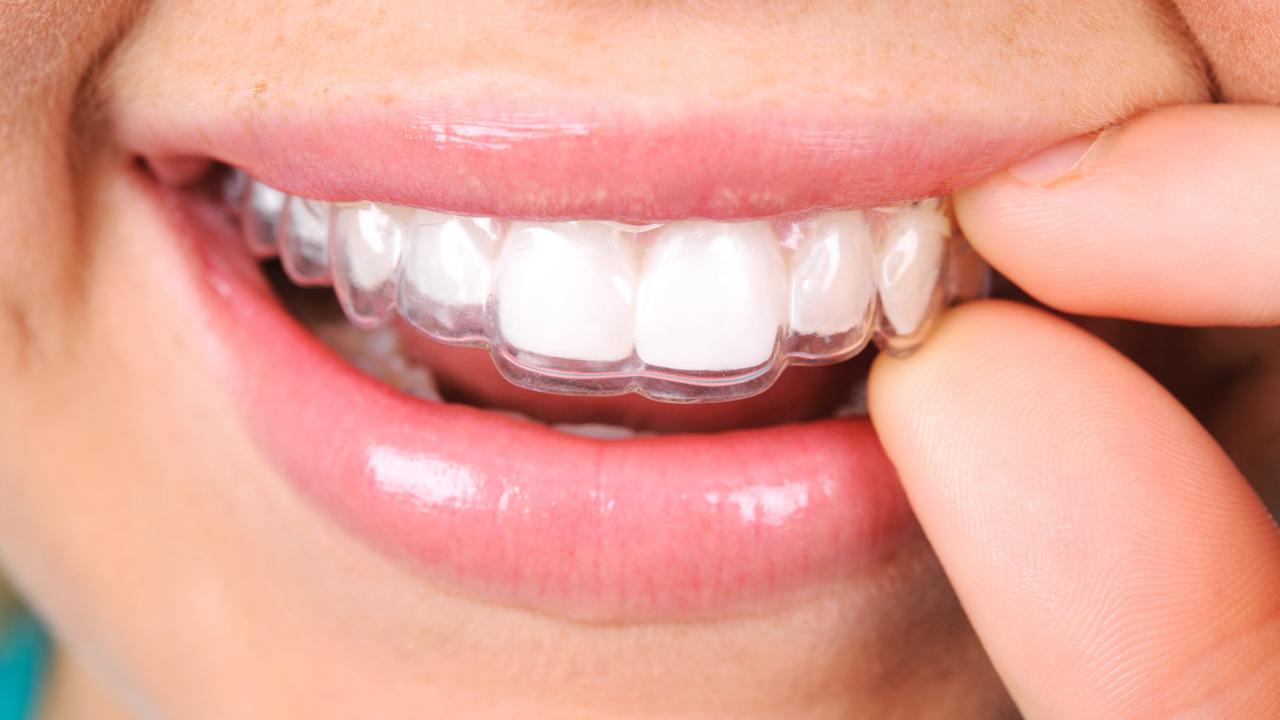 Techniques d'Orthodontie Invisibles : Gouttières et Orthodontie linguale